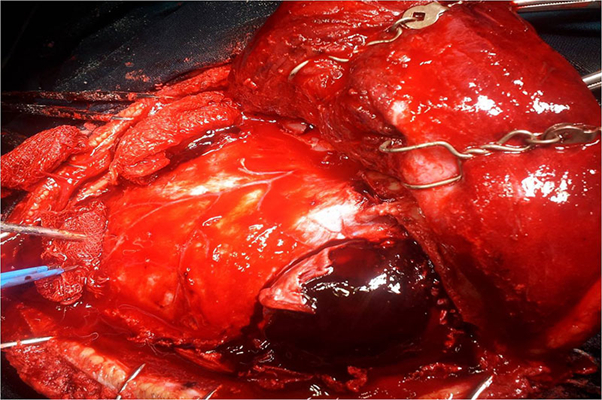 硬膜下血腫 (42) 