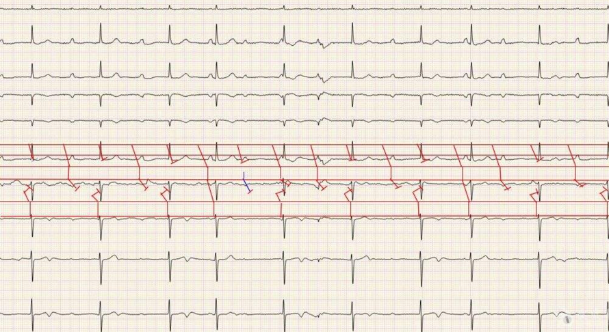 偶發房性早搏 (50) 