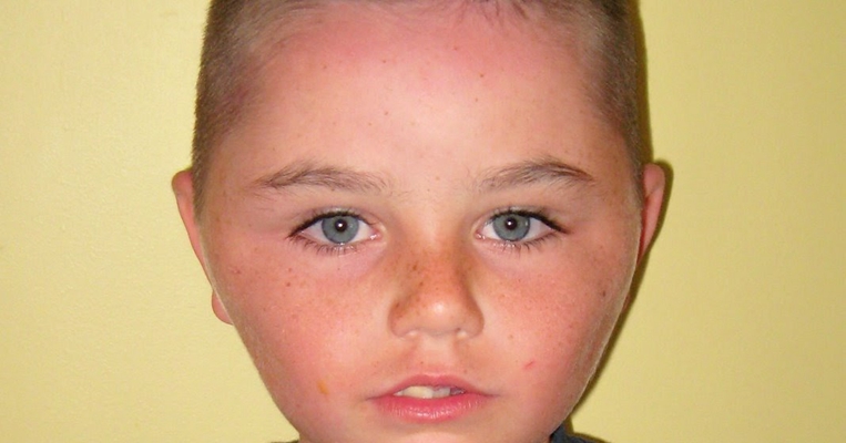 腮腺炎的症狀和