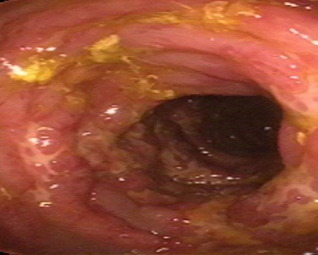 慢性結腸炎症狀患者