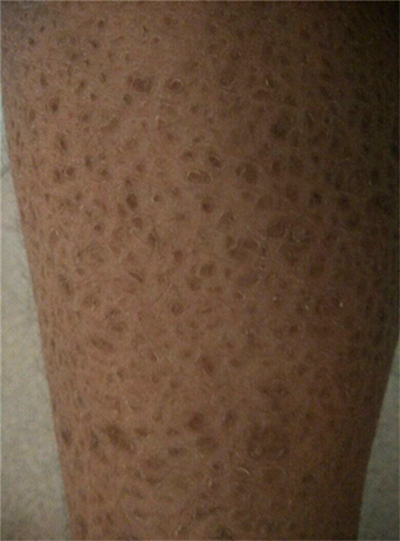 小腿皮膚像魚鱗 (47) 