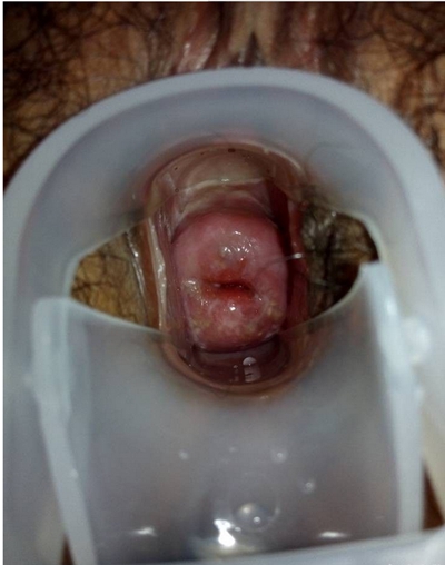 宮頸癌的早期症狀