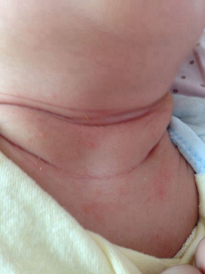 新生兒胎毒的症狀