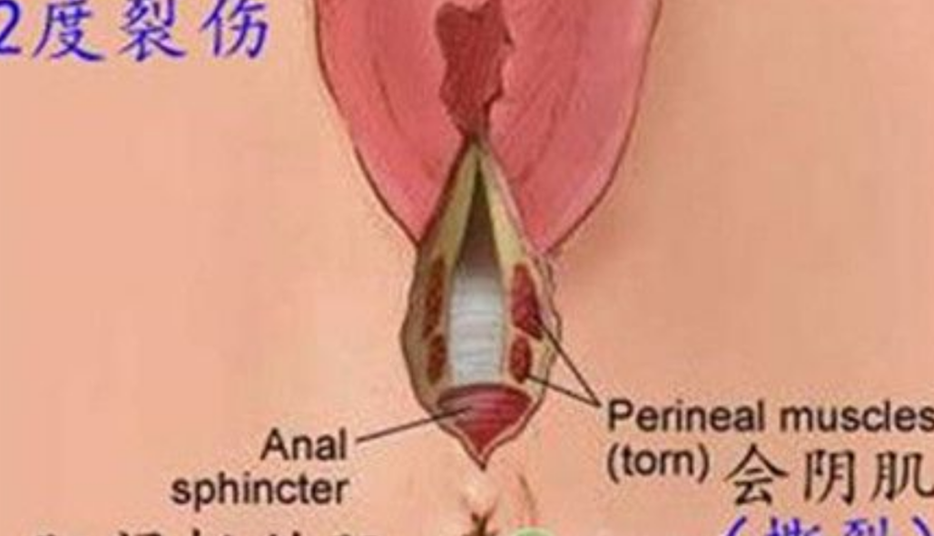 摔傷導致的會陰撕裂