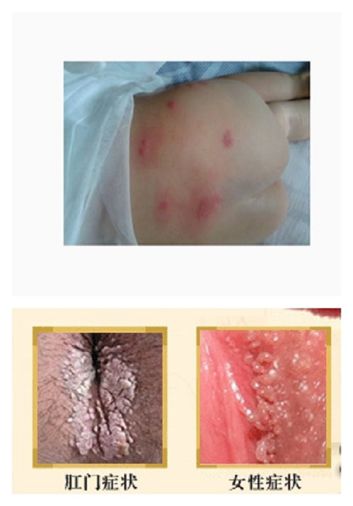 肛周溼疹和痔瘡的區別