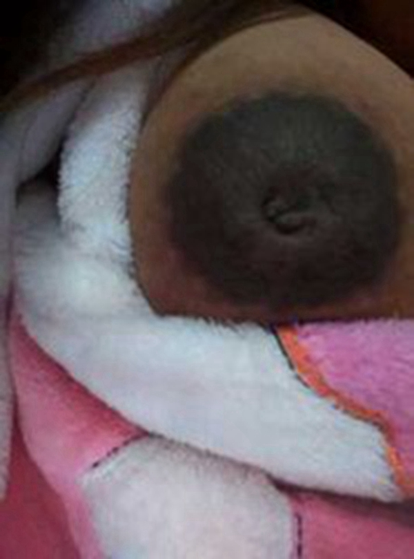 為什麼乳頭內陷