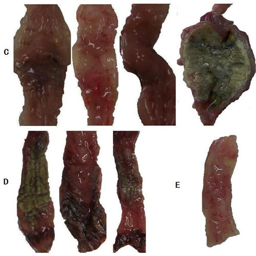 潰瘍性結腸炎手術切除物
