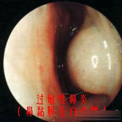 鼻息肉