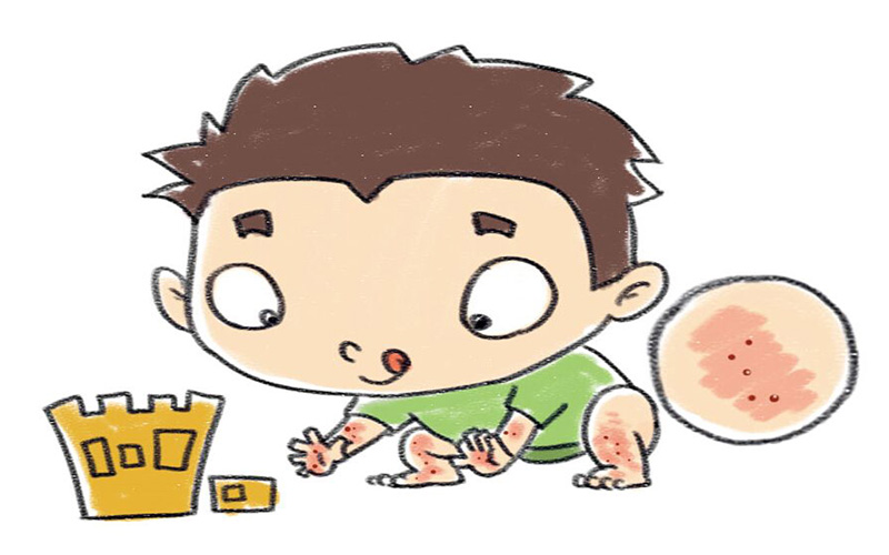 小兒放射性皮炎 