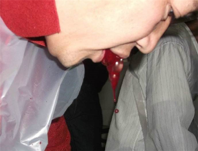 舌下取栓治療腦血栓