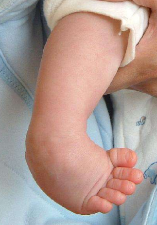 痙攣型腦癱 (54) 