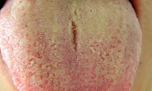 胃炎的症狀舌頭