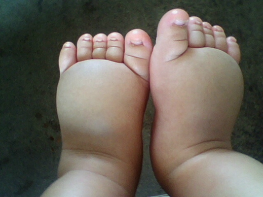 肢端肥大症  (49) 