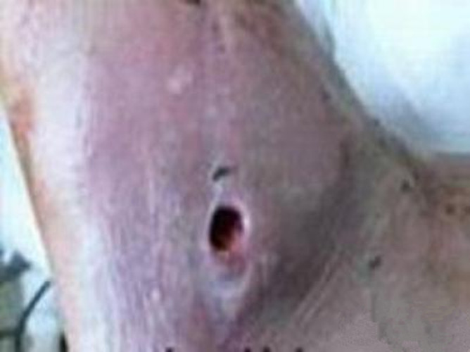 頜下淋巴結核潰爛