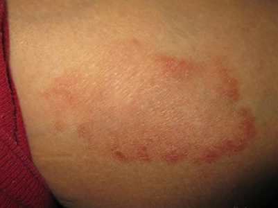 體股癬初期現象
