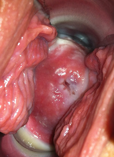 子宮肥大圖 (45) 