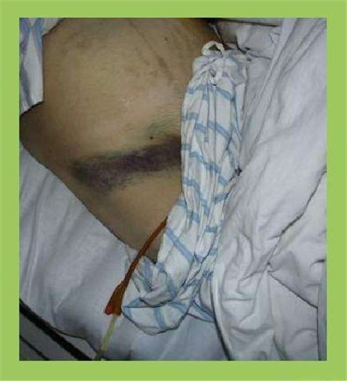 重症急性胰腺炎症狀