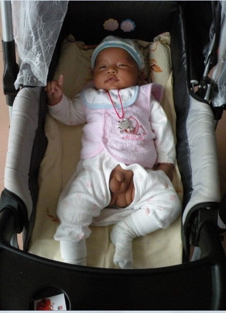 小兒鞘膜積液 (6) 