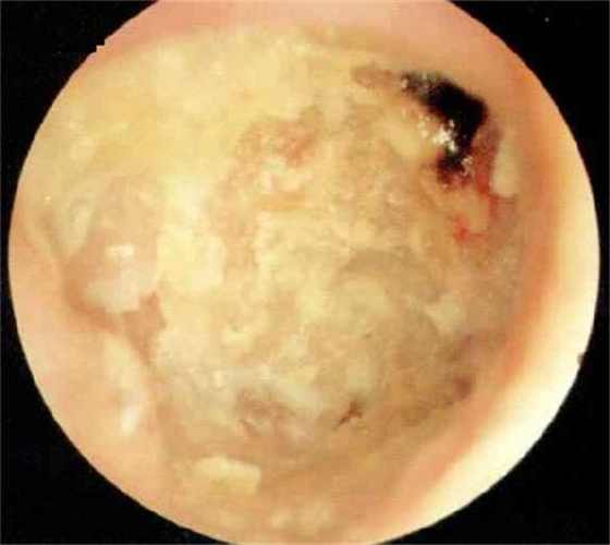 中耳炎使鼓膜穿孔