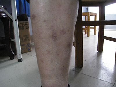 結節性癢疹 (40) 