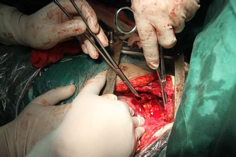 手術中肋骨骨折