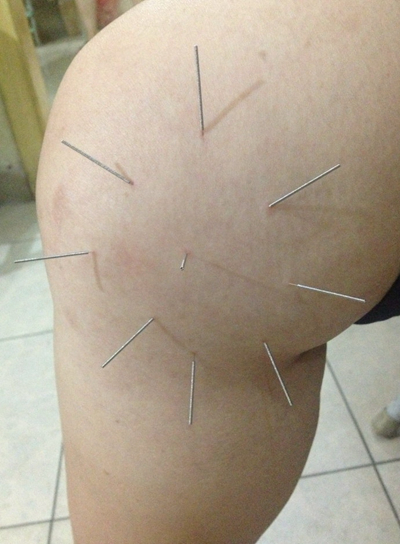 膝蓋半月板損傷症狀 (5) 