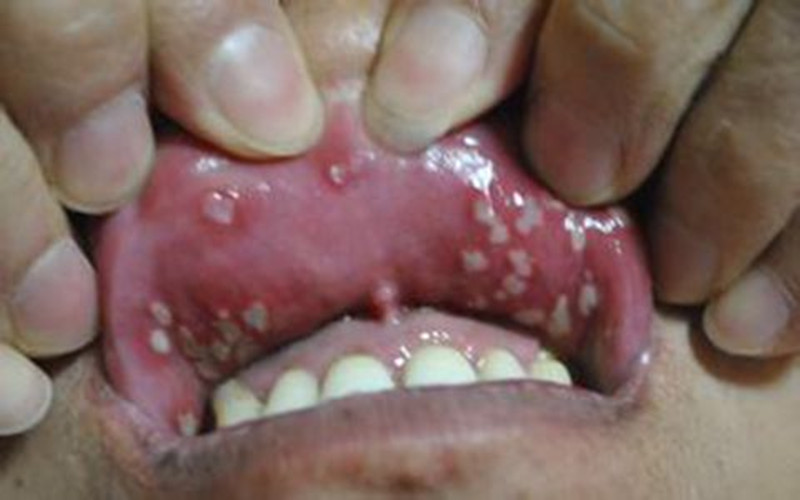 嘴裡麵皮膚結核病的