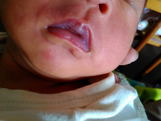 寶寶鵝口瘡 (75) 