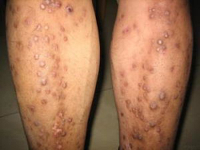 結節性癢疹 (31) 