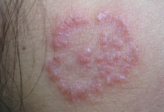 體股癬初期現象