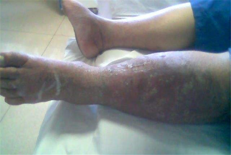 嚴重的下肢靜脈炎