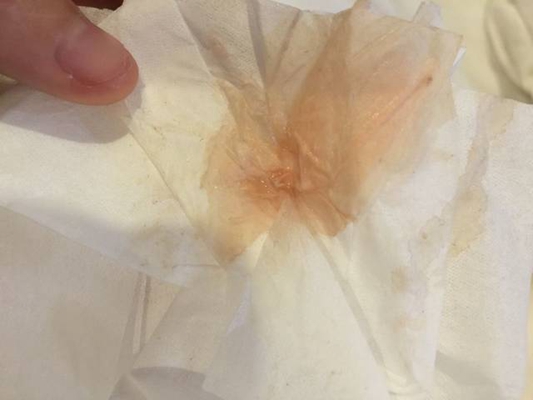 先兆流產分泌物