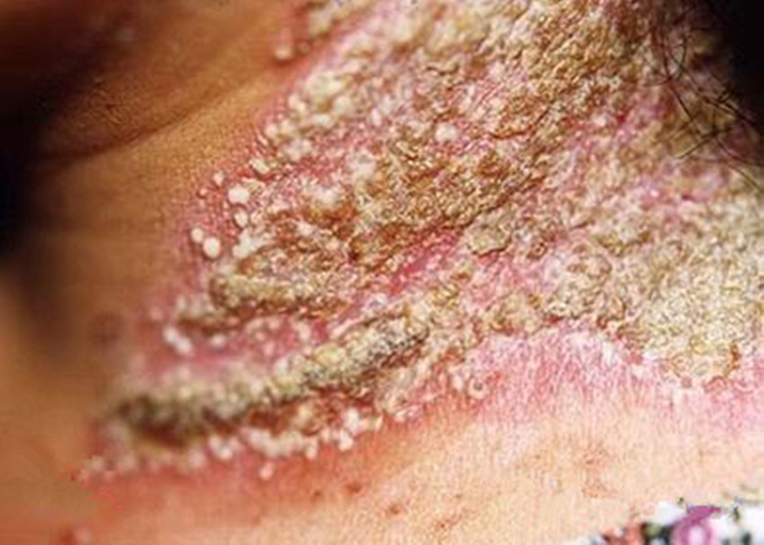 大皰性皮膚病頸部皰疹樣膿皰病