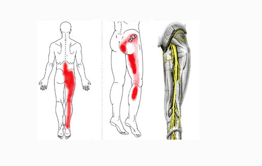 坐骨神經痛的症狀圖 (46) 