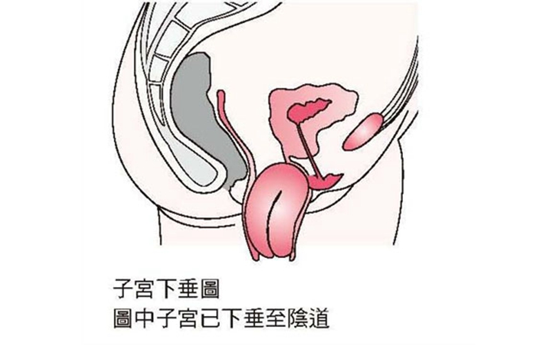 子宮脫垂至陰道的