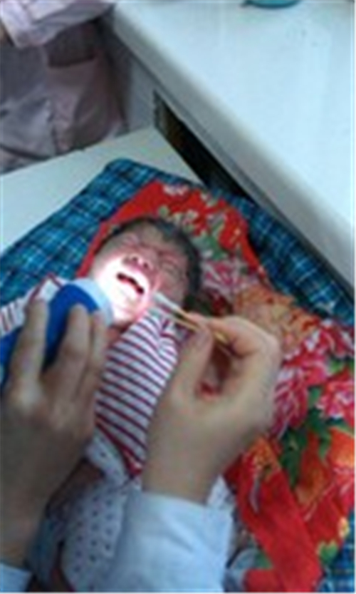 先天性喉喘鳴診察