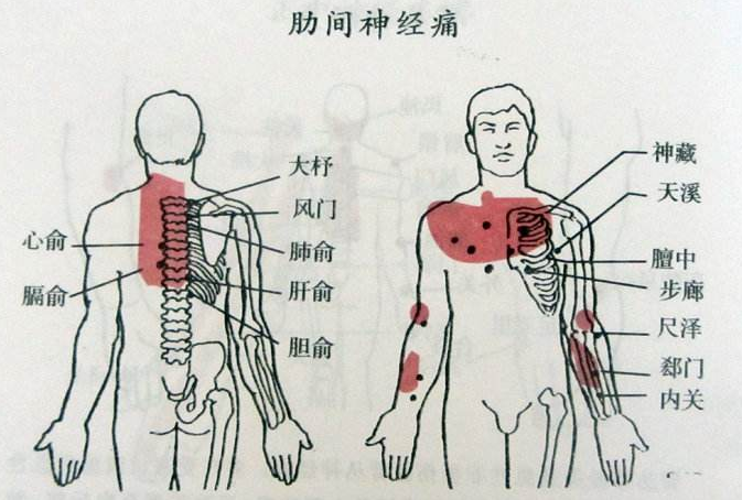 肋間神經炎疼痛部位