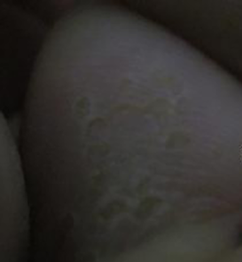 足底滑膜肉瘤早期症狀