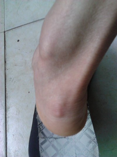 腳骨頭突出 (36) 