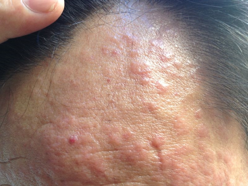 藥物性皮炎額頭上太多的疙瘩