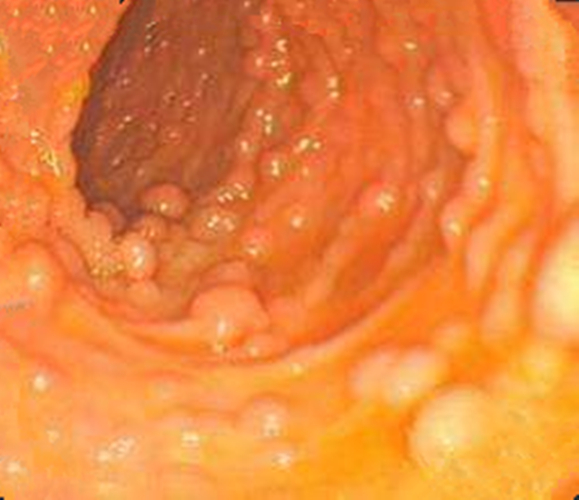 如何避免慢性結腸炎的