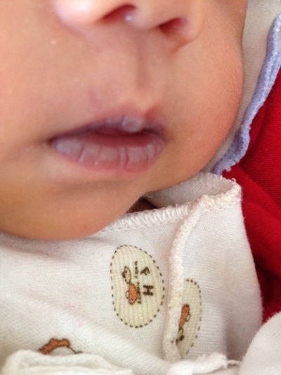 新生兒嘴唇發紫 (38) 