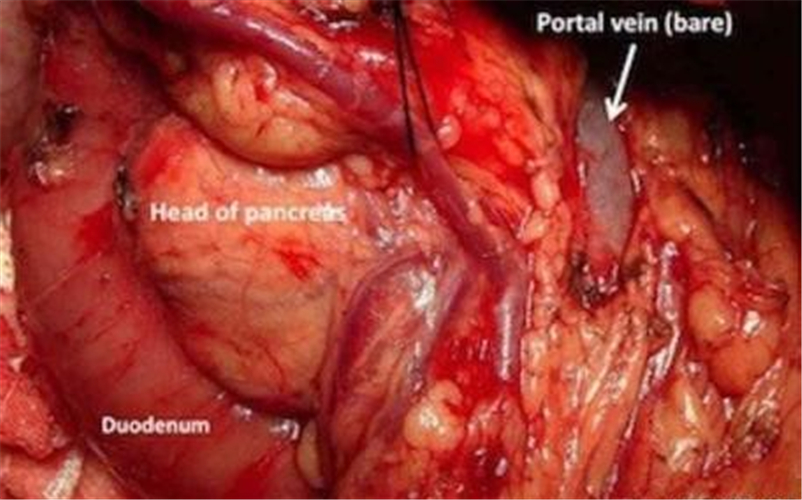 手術中的急性胰腺炎