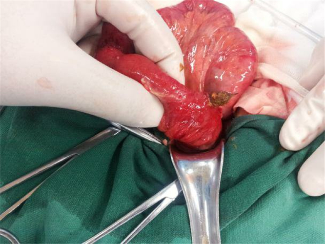 遠端迴腸腸粘連