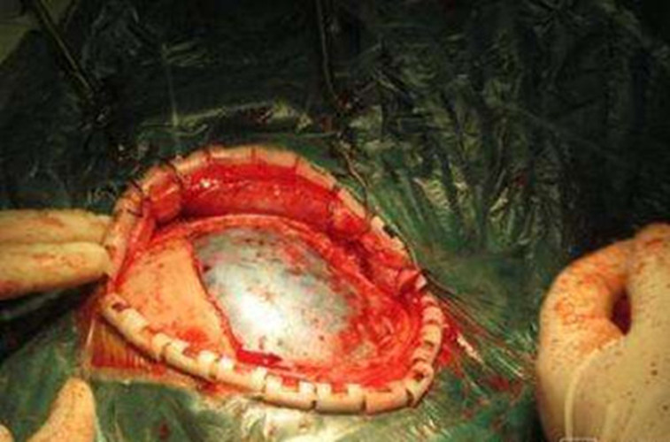 腦出血手術方法