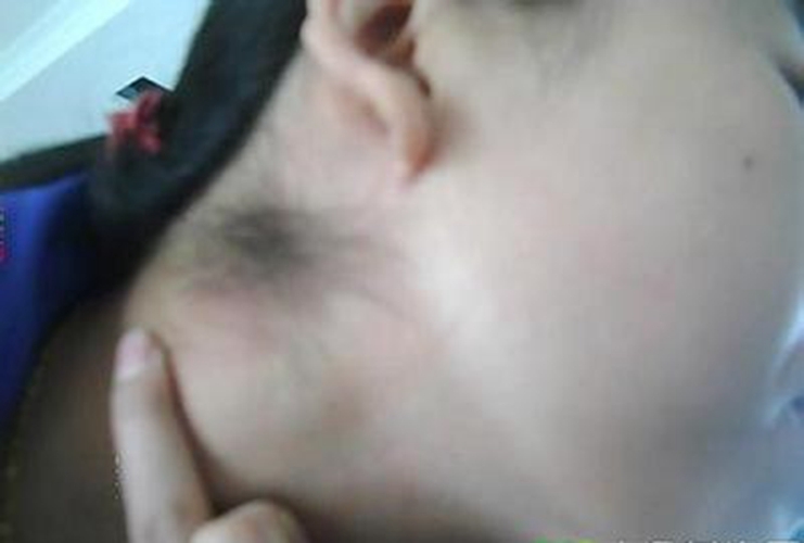 腋下的淋巴結髮炎女人的