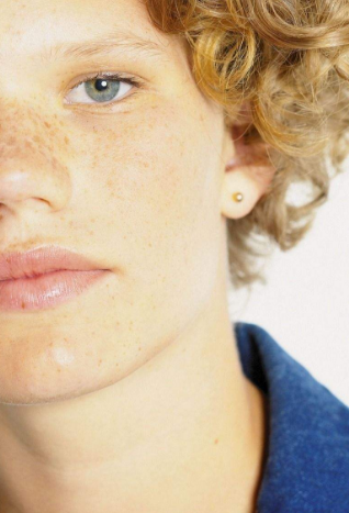 男人臉上長斑的