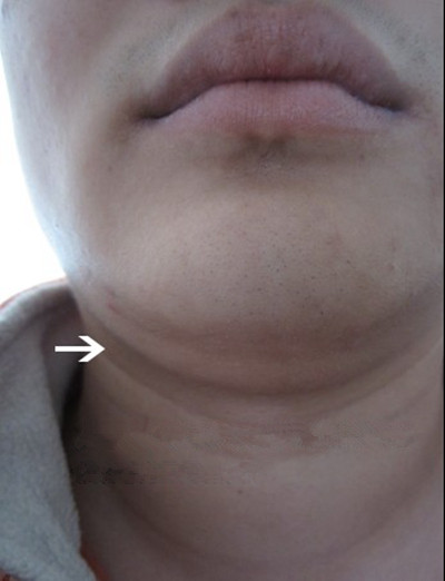 頜下淋巴結腫大