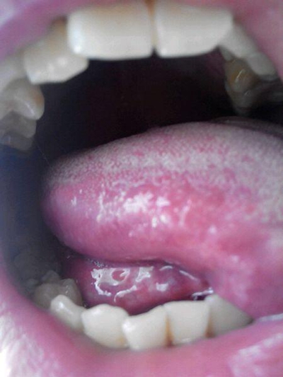 口腔念珠菌感染 (49) 