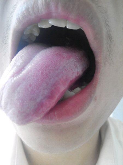 口腔念珠菌感染 (50) 